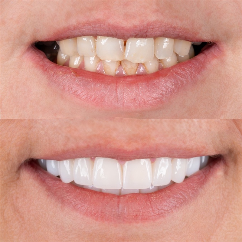 Răng sứ Orodent mang lại thẩm mỹ tự nhiên cao