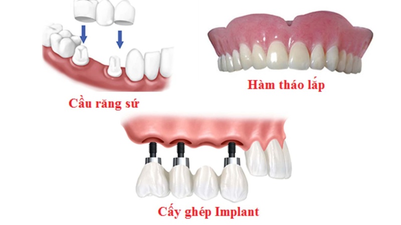So sánh trụ Implant Neodent và các phương pháp trồng răng truyền thống