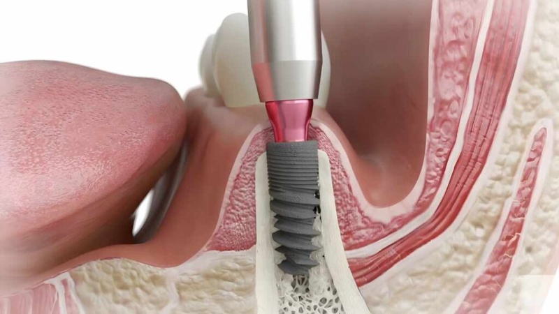 Thời gian tích hợp xương có thể lâu hơn các trụ Implant cao cấp