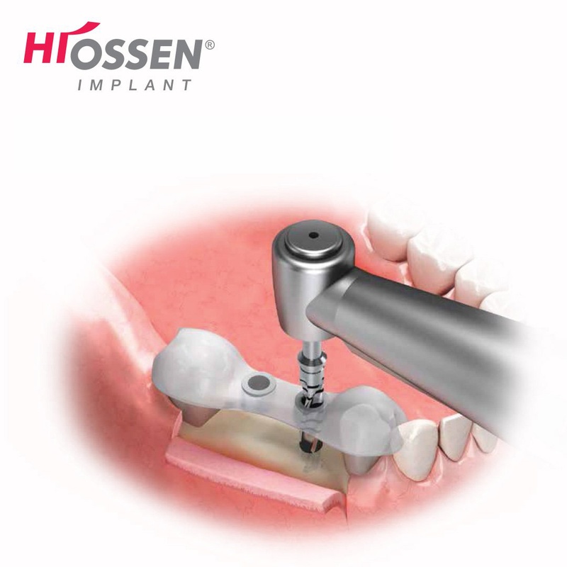 Trụ Implant chưa được sử dụng phổ biến tại thị trường Việt Nam