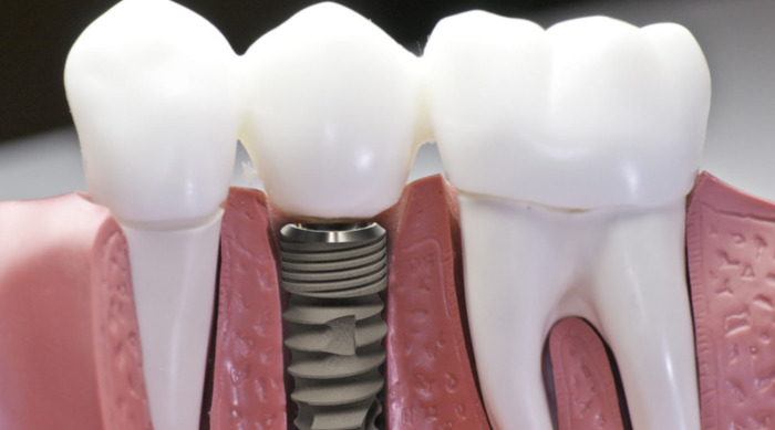 Trụ Implant DiO trước khi đưa ra thị trường phải trải qua quá trình kiểm định khắt khe bởi FDA Korea tại Hàn Quốc