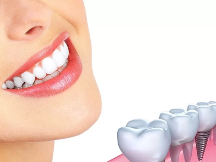 Implant Dio có thể ứng dụng cho hầu hết các trường hợp mất răng