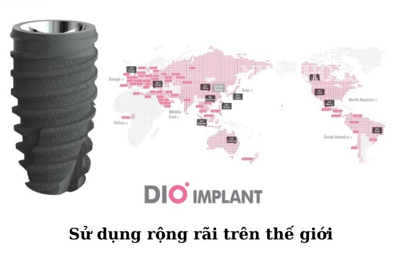 Trụ Implant DIO trở thành “ông lớn” trên thị trường Implant