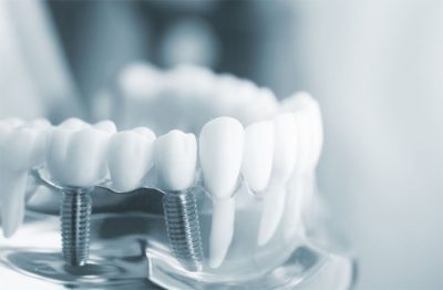 trụ implant tekka pháp
