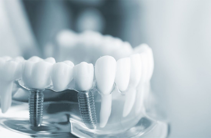 Trụ Implant Tekka được sản xuất tại Pháp