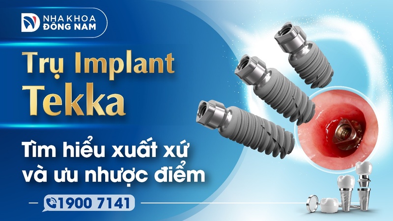 Trụ Implant Tekka – Tìm hiểu xuất xứ và ưu nhược điểm