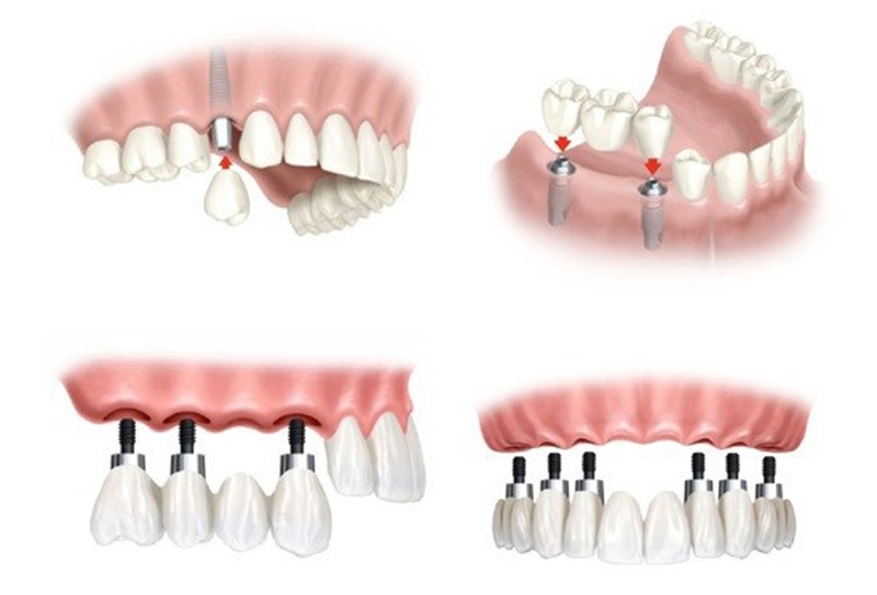 Trường hợp chỉ định cấy ghép Implant