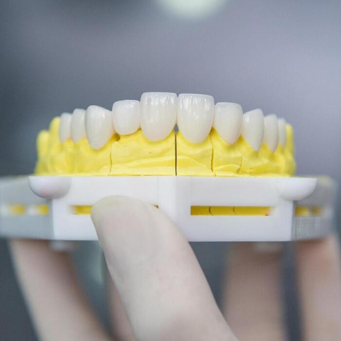 Răng sứ Hi-Zirconia có khả năng chống mài mòn và mang lại vẻ đẹp tự nhiên