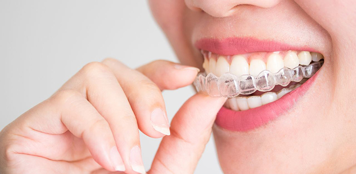 Chỉnh nha là phương pháp nhằm điều chỉnh vị trí răng và khớp cắn