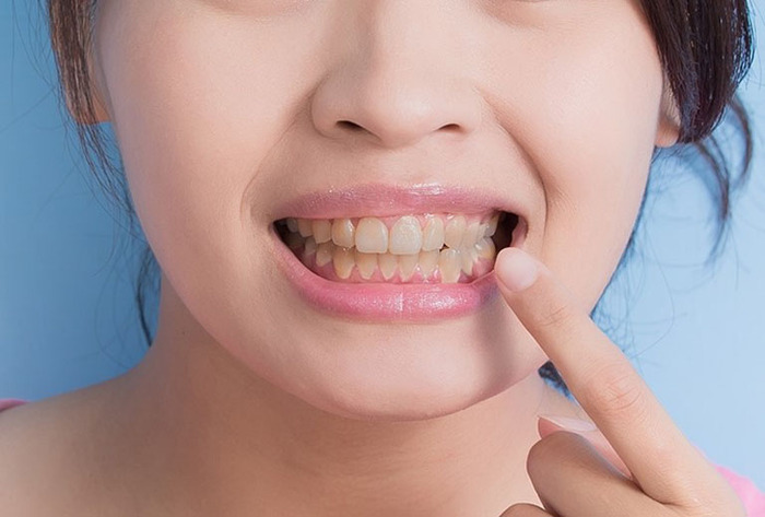 Khắc phục tình trạng răng xỉn màu