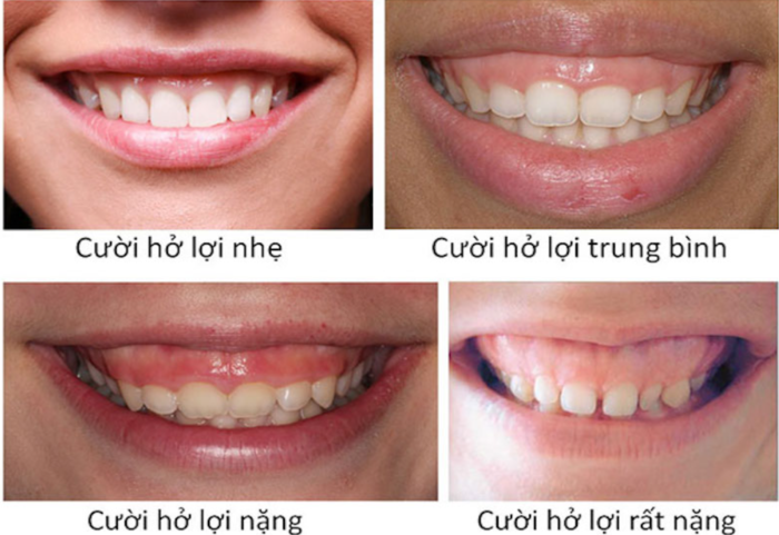 Cười hở lợi được chia thành 4 cấp độ