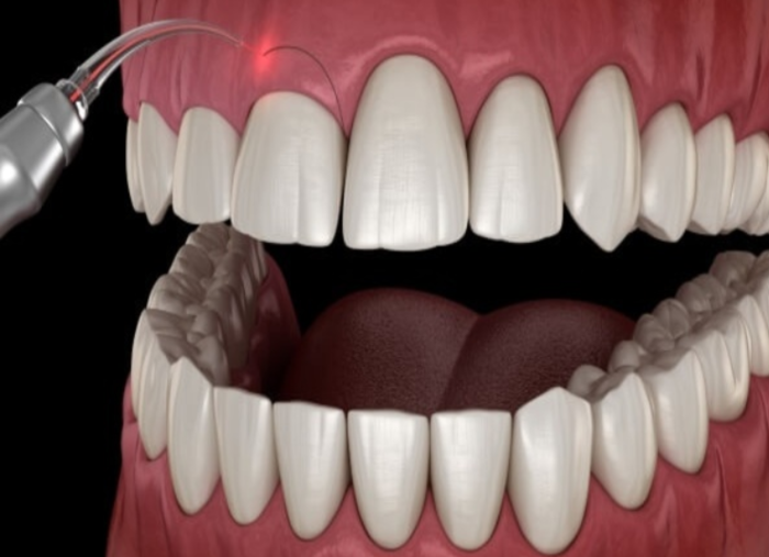 Điều trị cười hở lợi bằng phương pháp cắt nướu