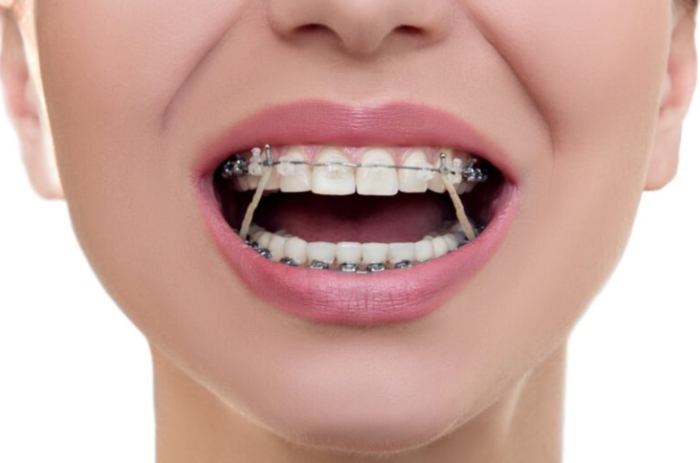 Niềng răng là giải pháp điều trị cười hở được nhiều người lựa chọn