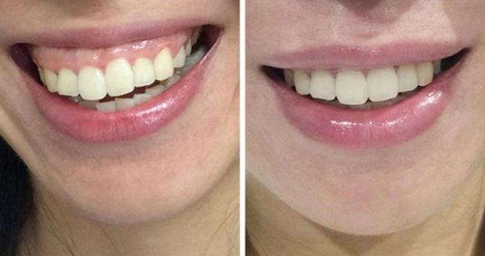 Điều trị cười hở lợi giúp mang lại nụ cười tự tin cho khách hàng