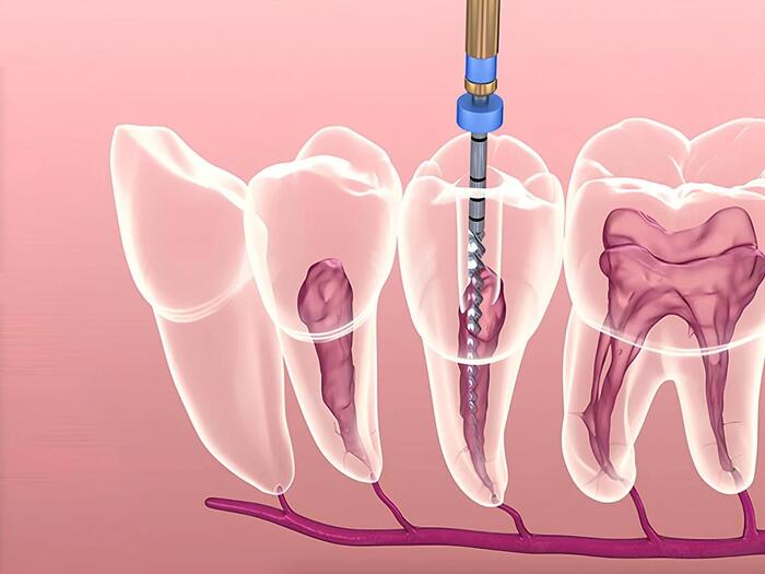 Điều trị bệnh lý về tủy răng