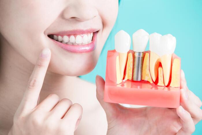 điều kiện để trồng răng implant