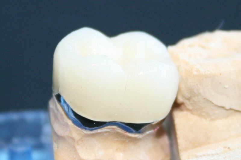 Dòng răng sứ kim loại Ceramco III có tuổi thọ ngắn