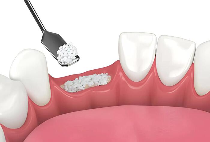 các loại xương nhân tạo