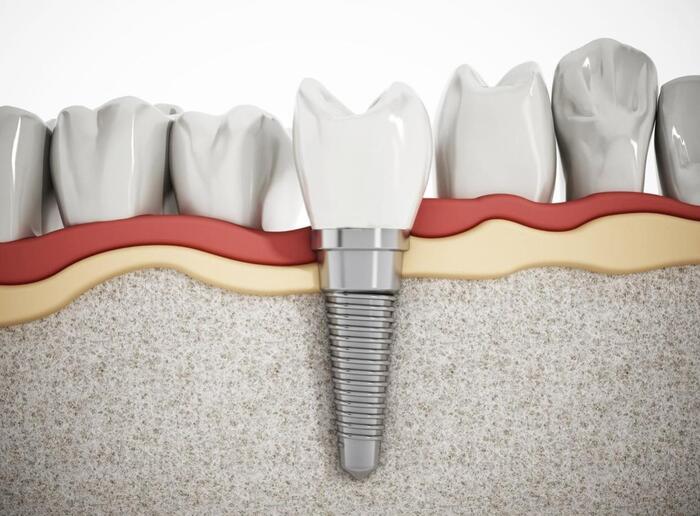 Mật độ xương hàm cần được đảm bảo để giữ trụ Implant vững chắc