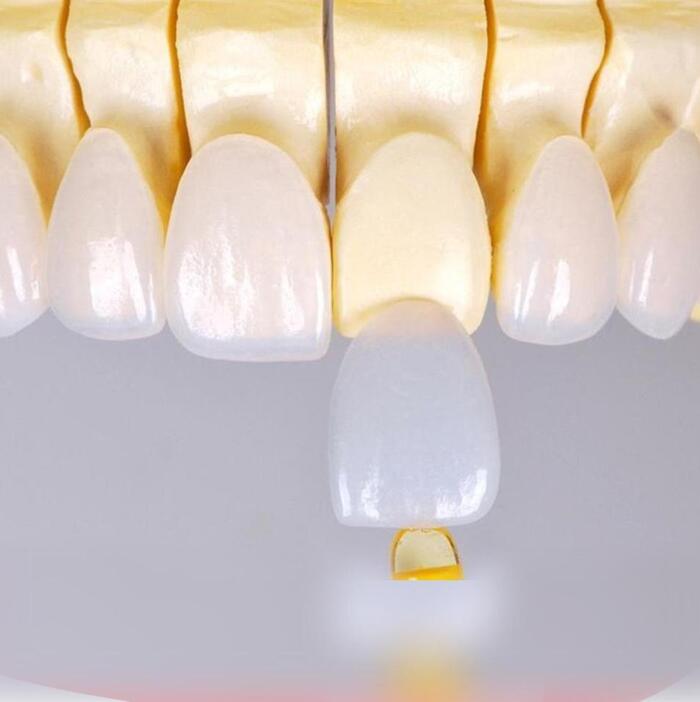 Dán sứ veneer