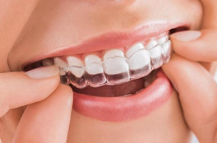 Phương pháp niềng răng là cách điều trị viêm khớp thái dương hàm