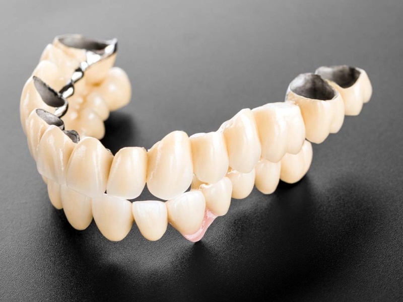 Răng sứ Ceramco III là gì?