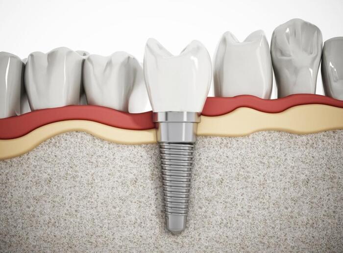 trồng răng implant có vĩnh viễn không