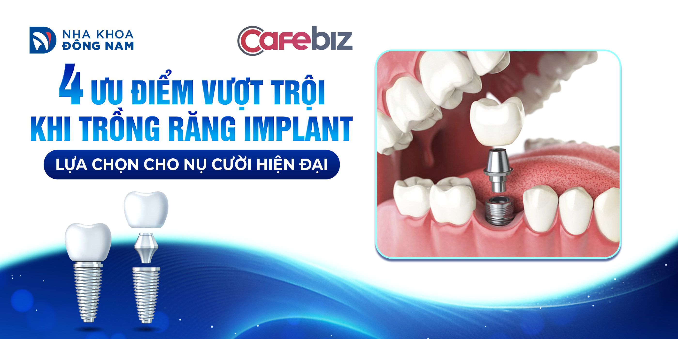 ưu điểm trồng răng Implant