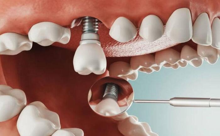 implant giá rẻ