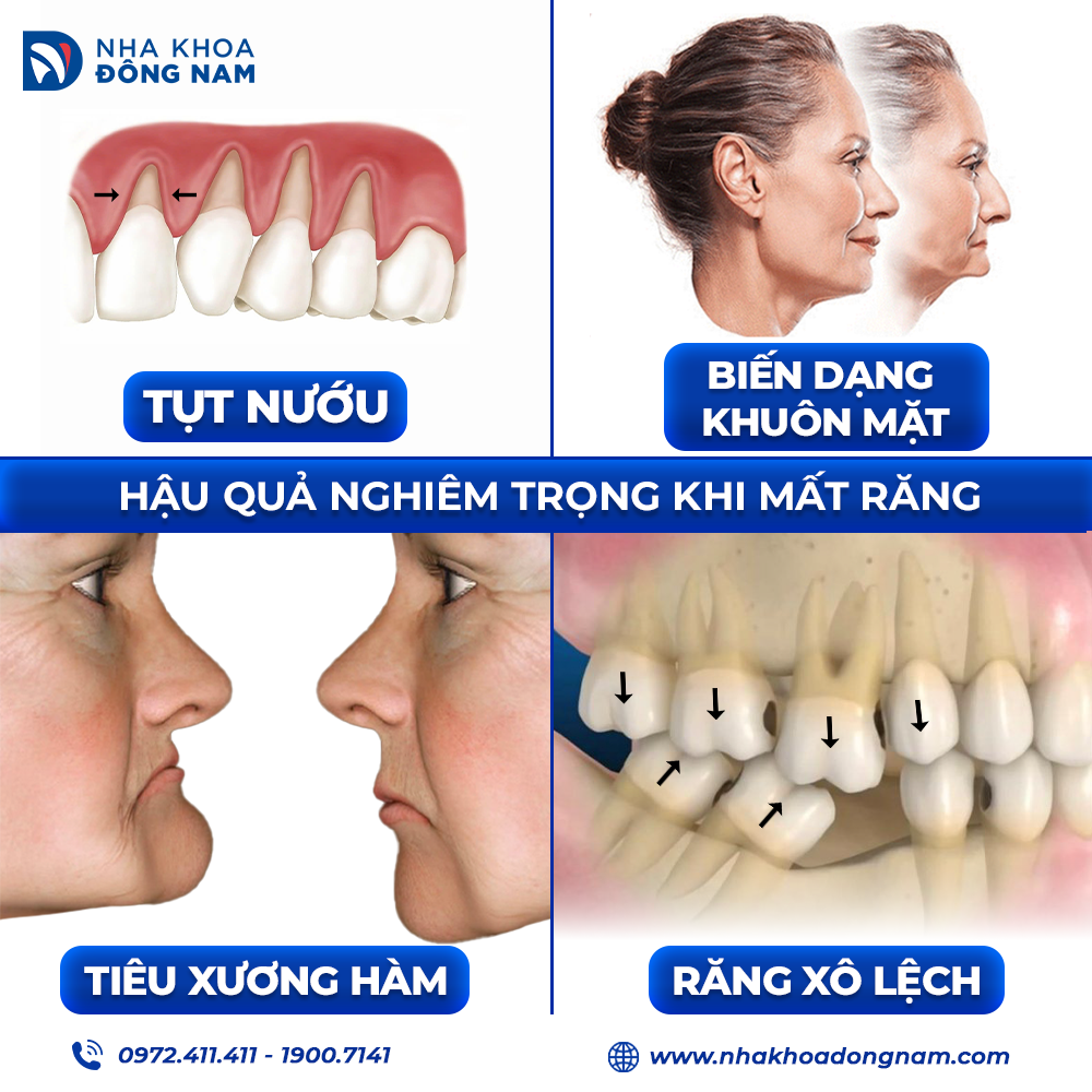 Trụ Implant đáp ứng nhiều tình trạng mất răng