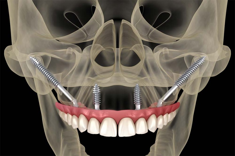 Áp dụng phương pháp Implant xương gò má cho trường hợp tiêu xương nghiêm trọng