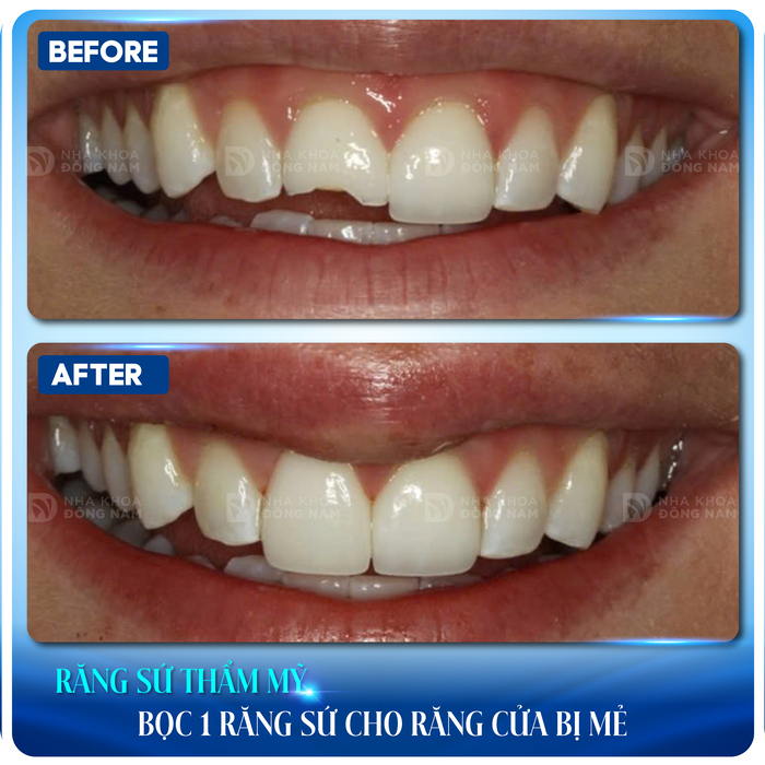 Bọc răng sứ cho răng cửa bị mẻ