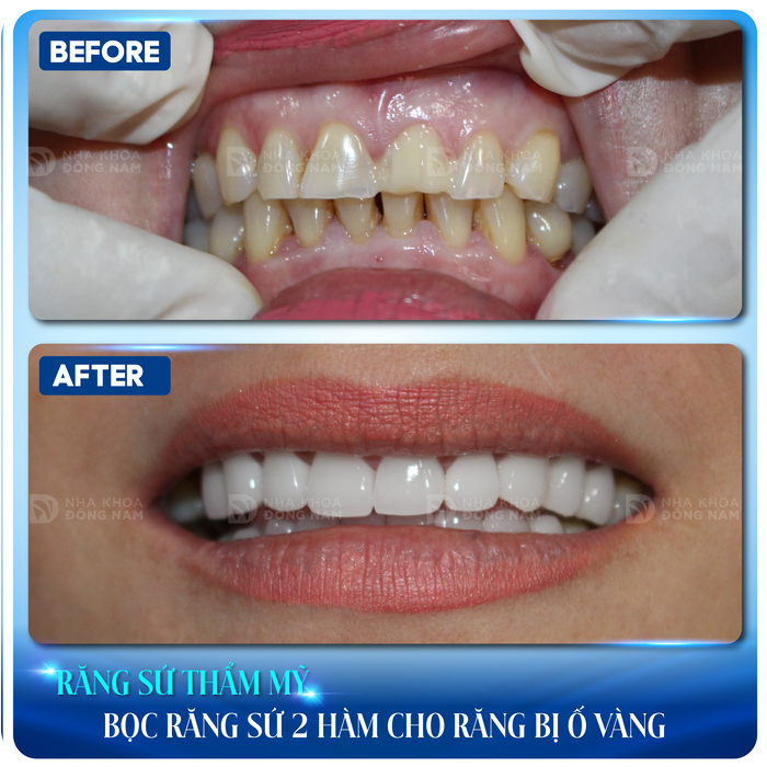 Khách hàng bọc răng sứ cho răng bị ố vàng