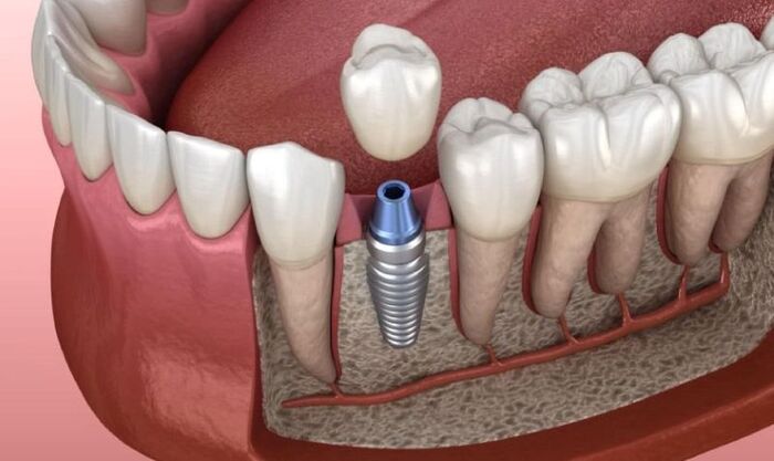 sai lầm nghiêm trọng khi cấy ghép xương