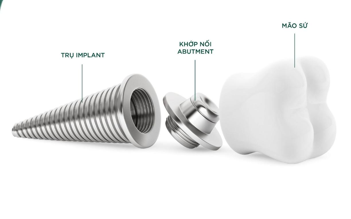 Cấu tạo răng Implant
