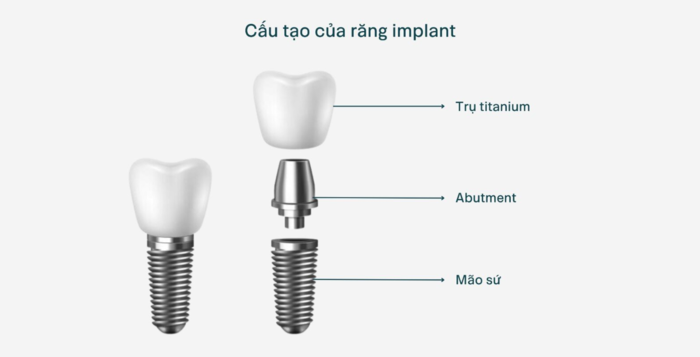 cấu tạo răng implant