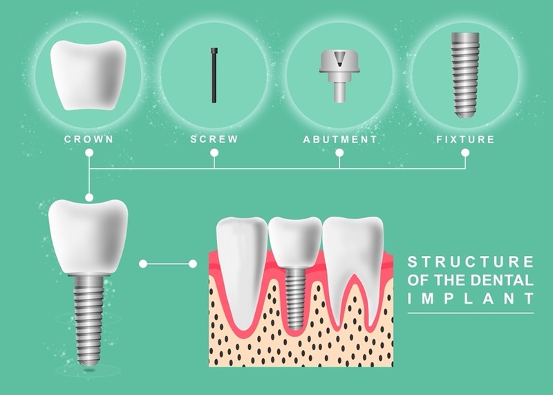 Cấu tạo trụ Implant tương tự như chiếc răng sinh lý