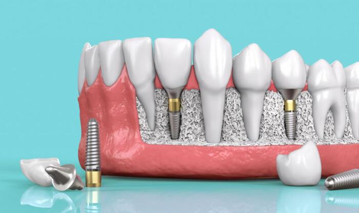 Trụ Implant Đức được ưa chuộng vì an toàn cho sức khỏe và thẩm mỹ