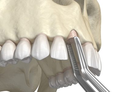 cấy ghép xương khối