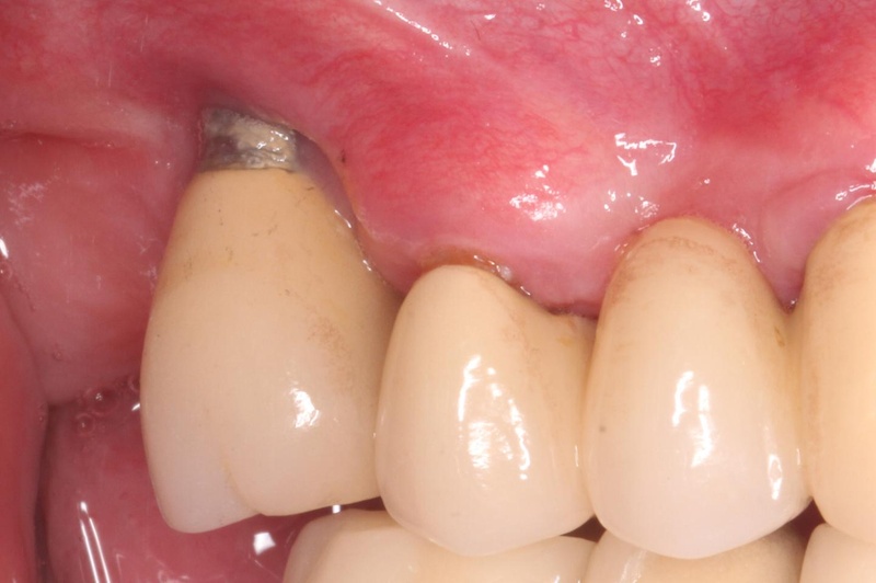 Chất lượng trụ Implant kém hoặc cấy không đúng kỹ thuật có thể gây ra đau nhức