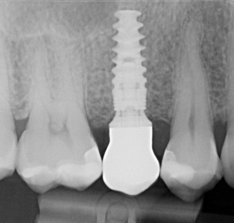 Chất lượng xương hàm cũng như sức khỏe khách hàng tốt giúp tăng tuổi thọ của Implant