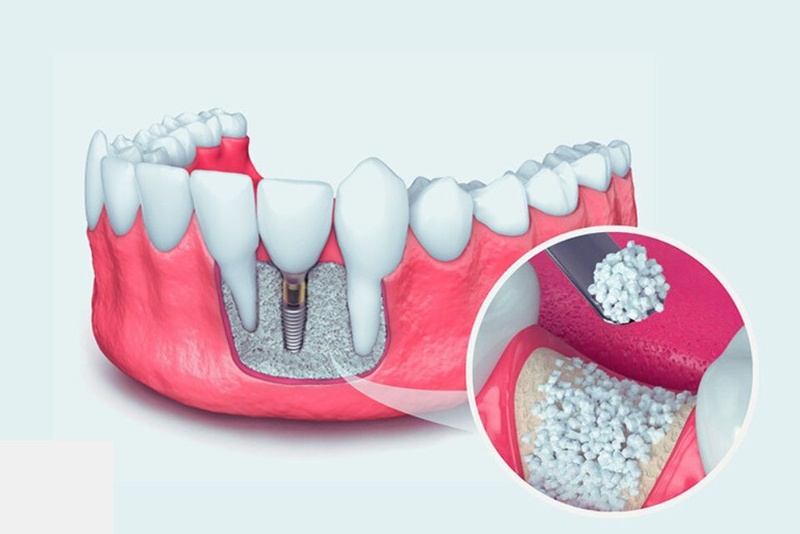 Chi phí ghép xương nhân tạo phụ thuộc nhiều yếu tố