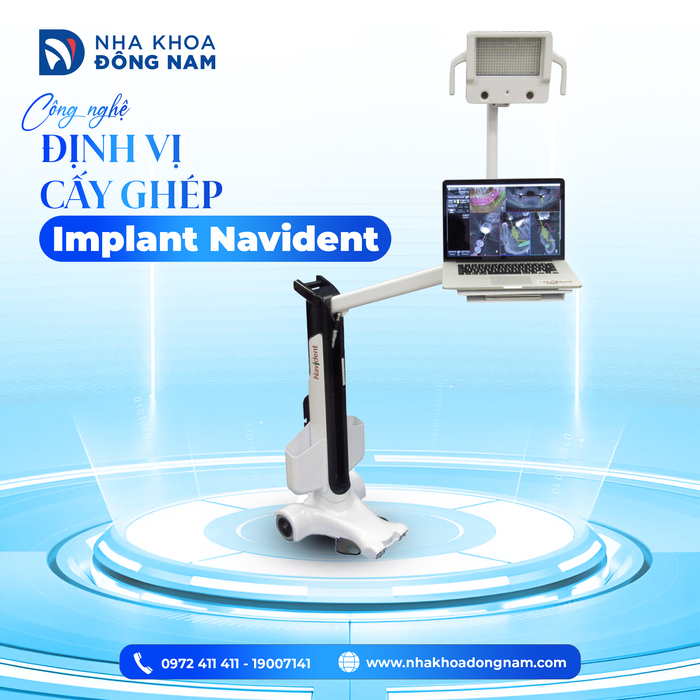 Là đơn vị tiên phong ứng dụng công nghệ định vị cấy ghép Implant Navident, đảm bảo an toàn và phục hình bền chắc.