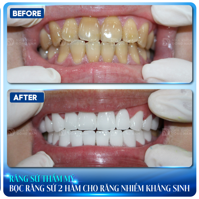 Bọc răng sứ cải thiện thẩm mỹ cho răng bị nhiễm kháng sinh