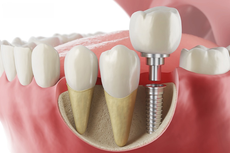 Đối tượng phù hợp Implant Thụy Sĩ