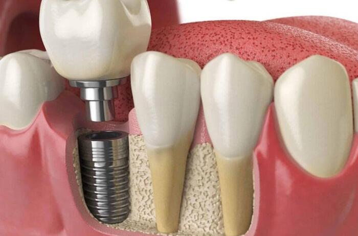Gắn mão sứ lên trụ Implant là hoàn tất quy trình
