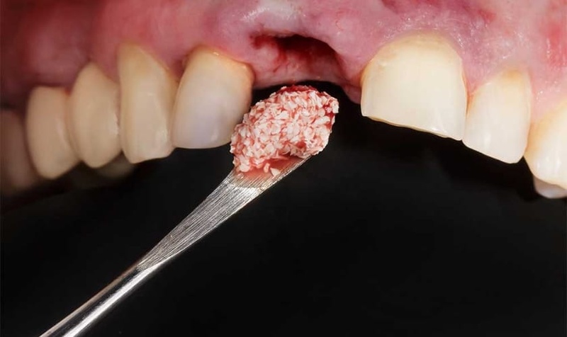 Ghép xương trong trường hợp răng Implant biến chứng gây tiêu xương