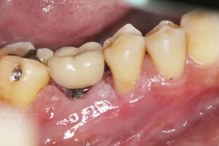 Các mô răng lân cận bị ảnh hưởng