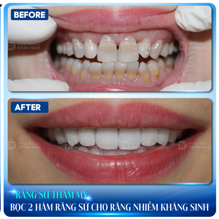 Khách hàng bọc răng sứ cho răng bị nhiễm kháng sinh