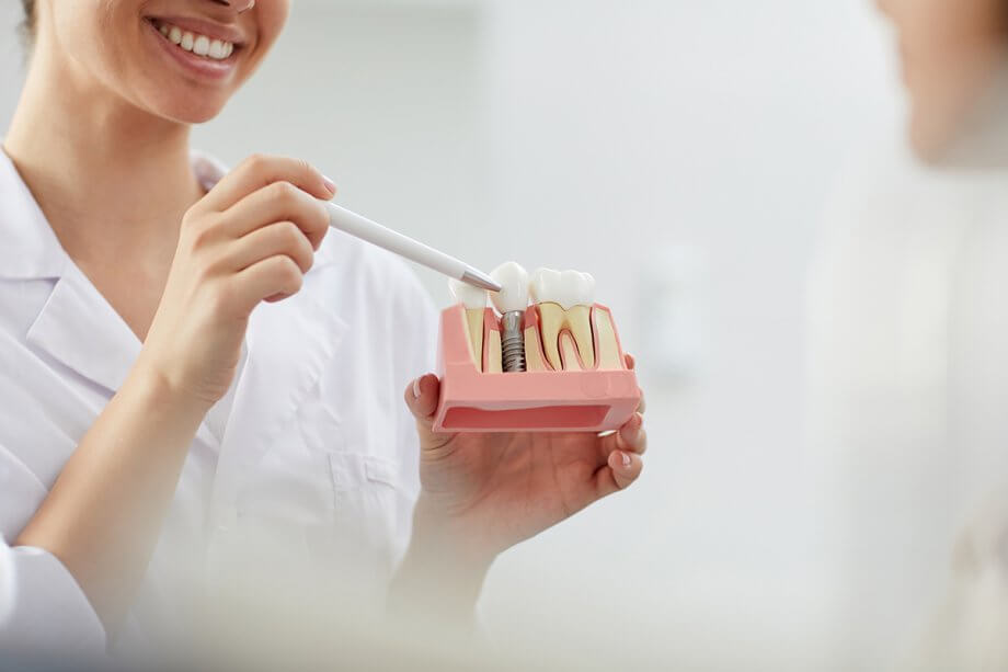 Loại trụ Implant phù hợp